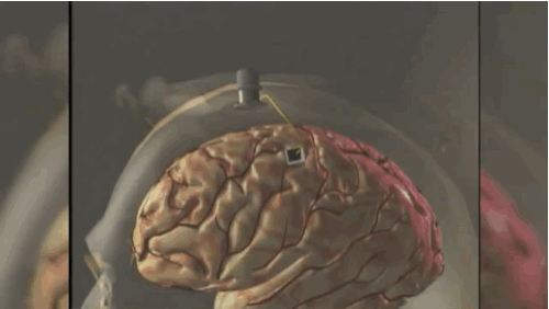 A tiny brain implant was “reading” Hutchinson’s thoughts.