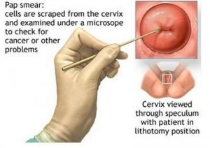 Cervical cancer stages hot pics