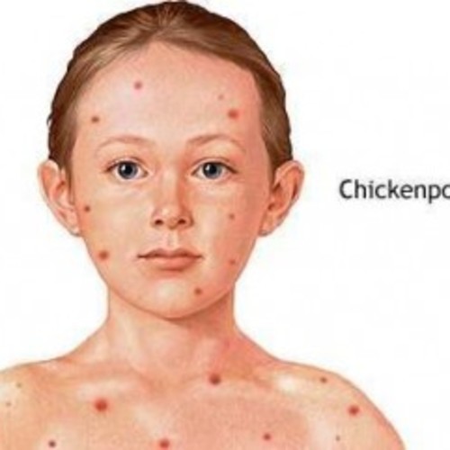 Pictures of roseola rash in children